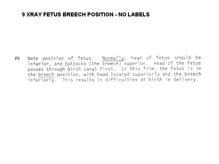9 XRAY FETUS BREECH POSITION - NO LABELS 