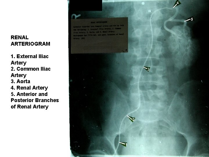 RENAL ARTERIOGRAM 1. External Iliac Artery 2. Common Iliac Artery 3. Aorta 4. Renal