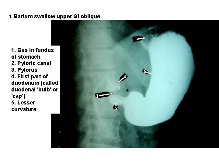 1 Barium swallow upper GI oblique 1. Gas in fundus of stomach 2. Pyloric