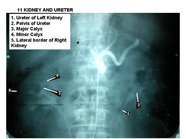 11 KIDNEY AND URETER 1. Ureter of Left Kidney 2. Pelvis of Ureter 3.