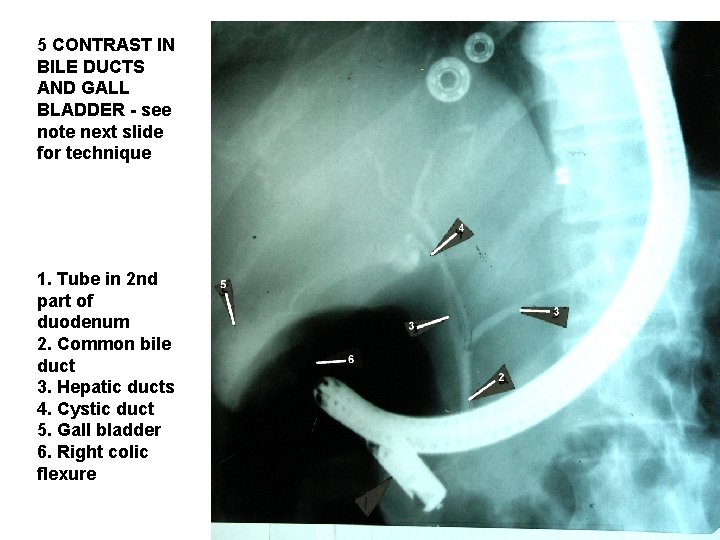 5 CONTRAST IN BILE DUCTS AND GALL BLADDER - see note next slide for