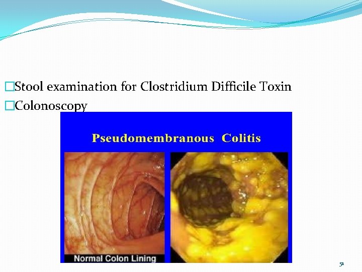 �Stool examination for Clostridium Difficile Toxin �Colonoscopy 51 