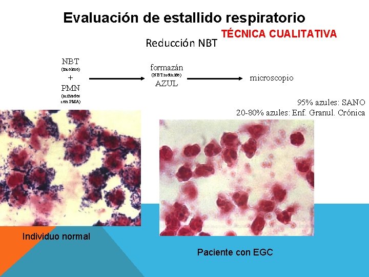 Evaluación de estallido respiratorio Reducción NBT (incoloro) + PMN (activados con PMA) TÉCNICA CUALITATIVA