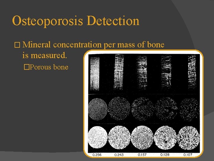 Osteoporosis Detection � Mineral concentration per mass of bone is measured. �Porous bone 