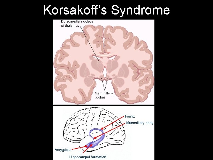 Korsakoff’s Syndrome 