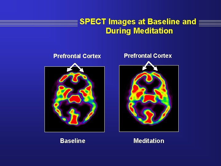 SPECT Images at Baseline and During Meditation Prefrontal Cortex Baseline Prefrontal Cortex Meditation 