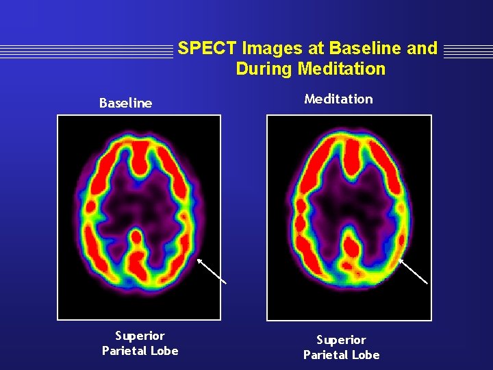 SPECT Images at Baseline and During Meditation Baseline Meditation Superior Parietal Lobe 