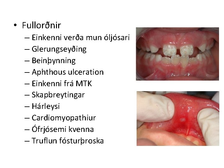  • Fullorðnir – Einkenni verða mun óljósari – Glerungseyðing – Beinþynning – Aphthous