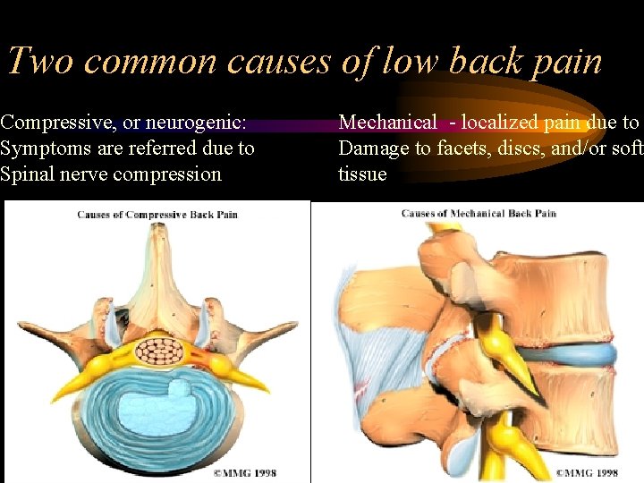 Two common causes of low back pain Compressive, or neurogenic: Symptoms are referred due