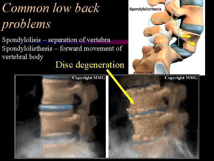 Common low back problems Spondylolisis – separation of vertebra Spondylolisthesis – forward movement of