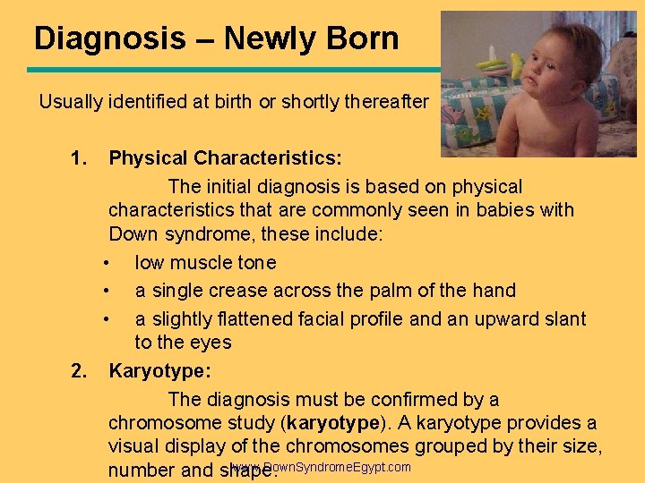 Diagnosis – Newly Born Usually identified at birth or shortly thereafter 1. Physical Characteristics: