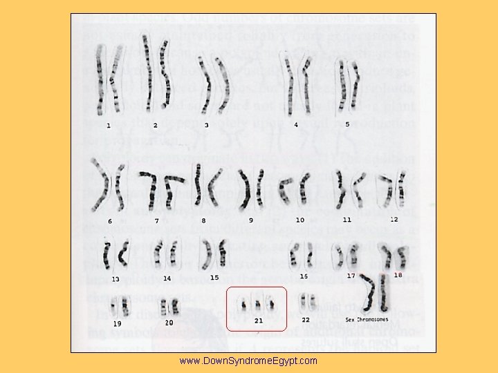 www. Down. Syndrome. Egypt. com 