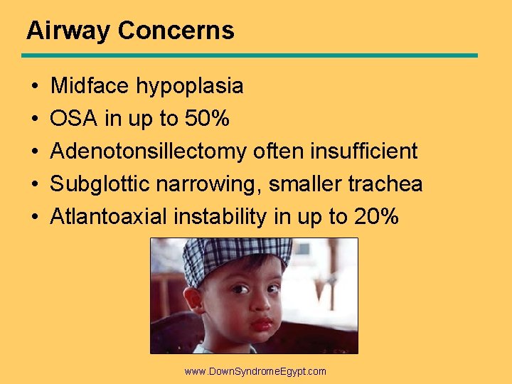 Airway Concerns • • • Midface hypoplasia OSA in up to 50% Adenotonsillectomy often