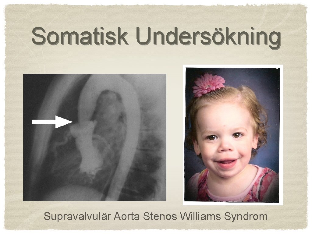 Somatisk Undersökning Supravalvulär Aorta Stenos Williams Syndrom 