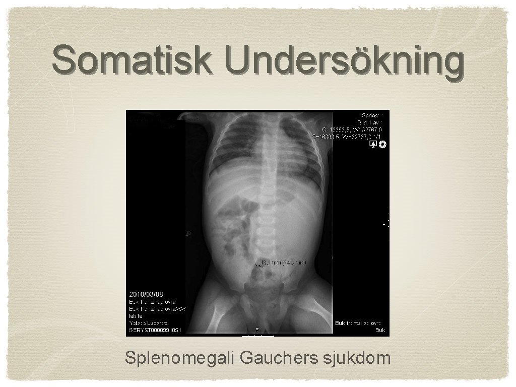 Somatisk Undersökning Splenomegali Gauchers sjukdom 