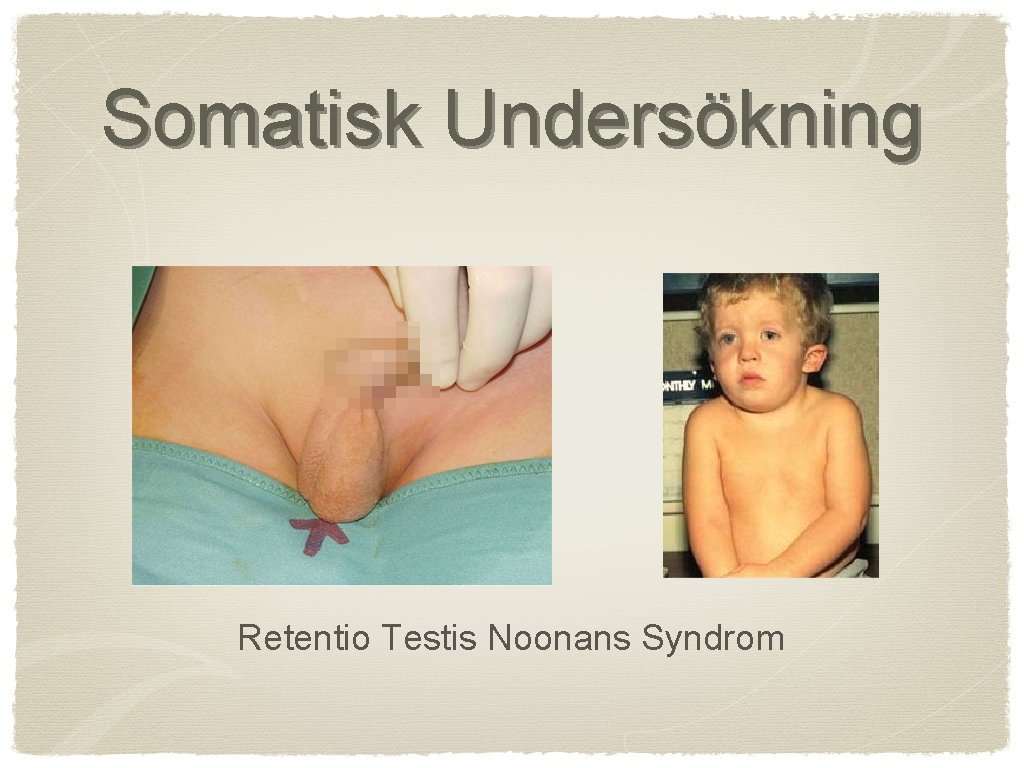 Somatisk Undersökning Retentio Testis Noonans Syndrom 