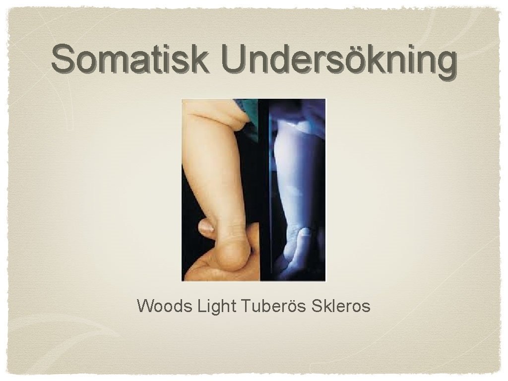 Somatisk Undersökning Woods Light Tuberös Skleros 