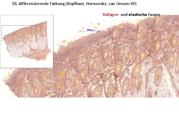 18. differenzierende Färbung (Kopfhaut, Hornowsky: van Gieson+RF) Kollagen- und elastische Fasern 
