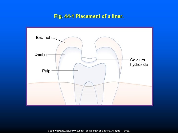 Fig. 44 -1 Placement of a liner. Copyright © 2009, 2006 by Saunders, an