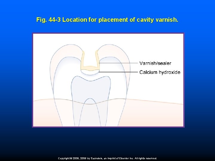 Fig. 44 -3 Location for placement of cavity varnish. Copyright © 2009, 2006 by