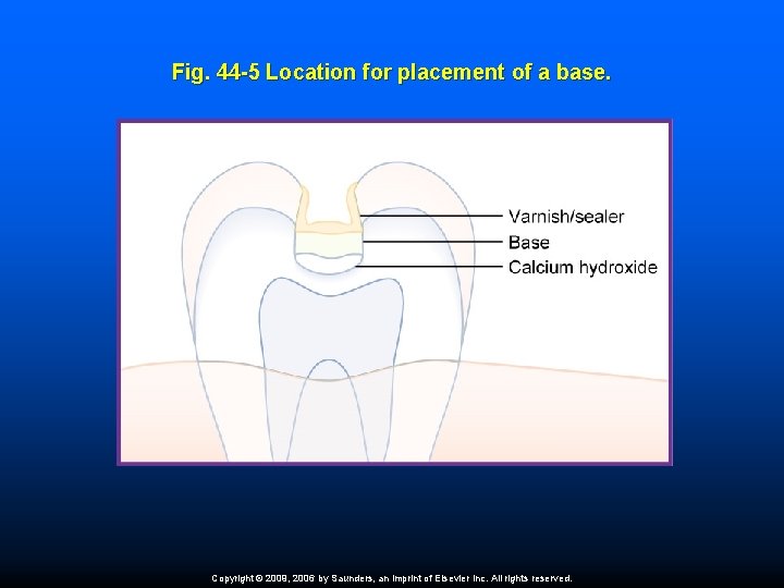 Fig. 44 -5 Location for placement of a base. Copyright © 2009, 2006 by