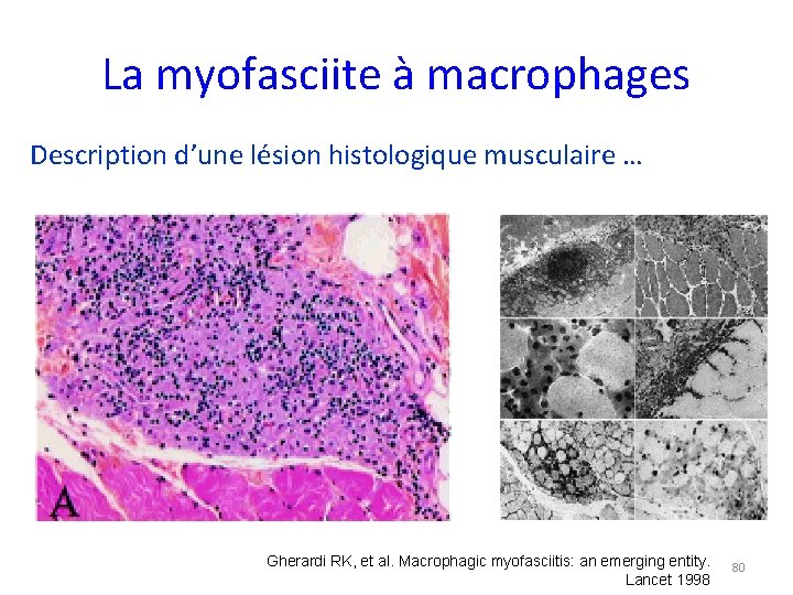 La myofasciite à macrophages Description d’une lésion histologique musculaire … Gherardi RK, et al.