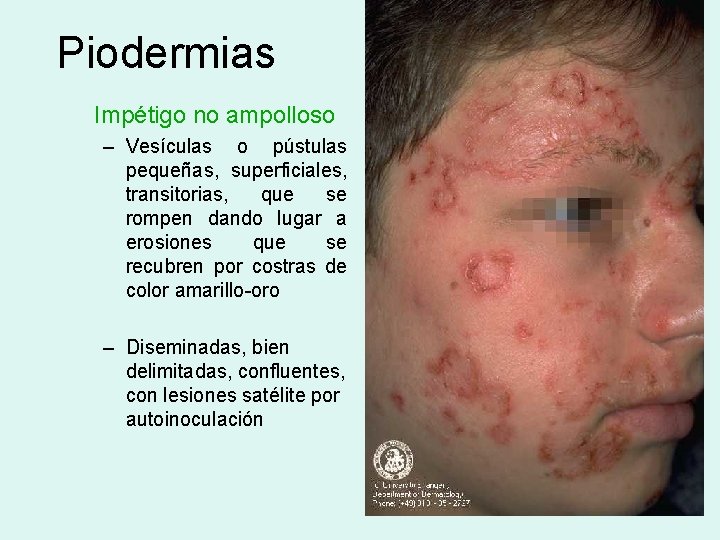 Piodermias Impétigo no ampolloso – Vesículas o pústulas pequeñas, superficiales, transitorias, que se rompen