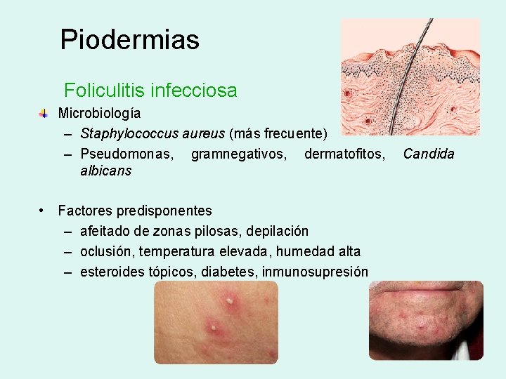 Piodermias Foliculitis infecciosa Microbiología – Staphylococcus aureus (más frecuente) – Pseudomonas, gramnegativos, dermatofitos, Candida