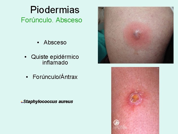 Piodermias Forúnculo. Absceso • Quiste epidérmico inflamado • Forúnculo/Ántrax Staphylococcus aureus 