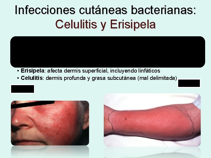 Infecciones cutáneas bacterianas: Celulitis y Erisipela Infecciones agudas y diseminadas de los tejidos dérmico