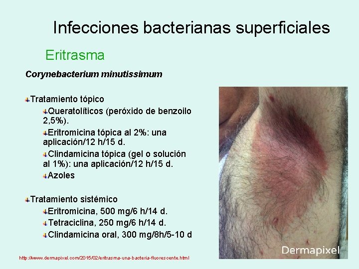 Infecciones bacterianas superficiales Eritrasma Corynebacterium minutissimum Tratamiento tópico Queratolíticos (peróxido de benzoilo 2, 5%).