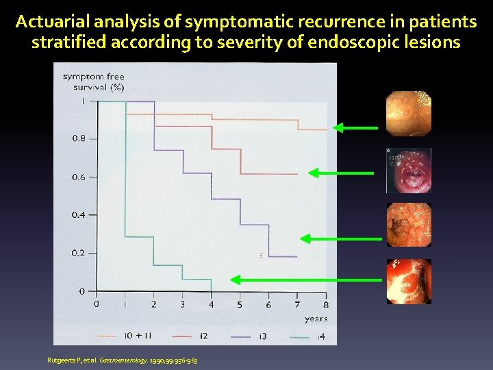Actuarial analysis of symptomatic recurrence in patients stratified according to severity of endoscopic lesions