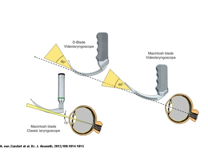 A. van Zundert et al. Br. J. Anaesth. 2012; 109: 1014 -1015 