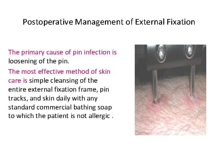 Postoperative Management of External Fixation The primary cause of pin infection is loosening of