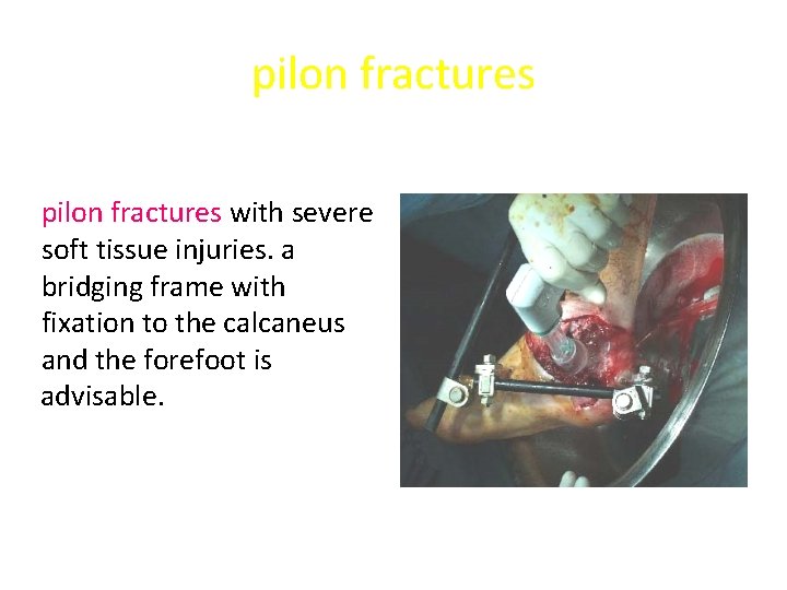 pilon fractures with severe soft tissue injuries. a bridging frame with fixation to the