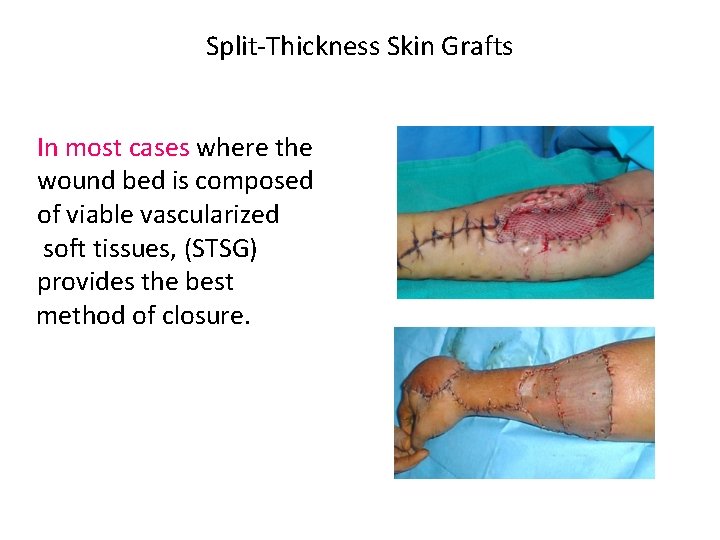 Split-Thickness Skin Grafts In most cases where the wound bed is composed of viable