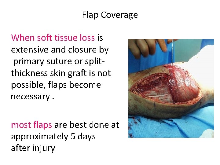 Flap Coverage When soft tissue loss is extensive and closure by primary suture or