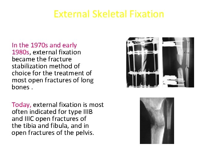 External Skeletal Fixation In the 1970 s and early 1980 s, external fixation became