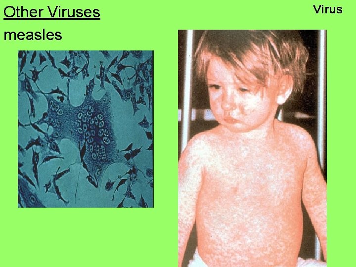 Other Viruses measles Virus 