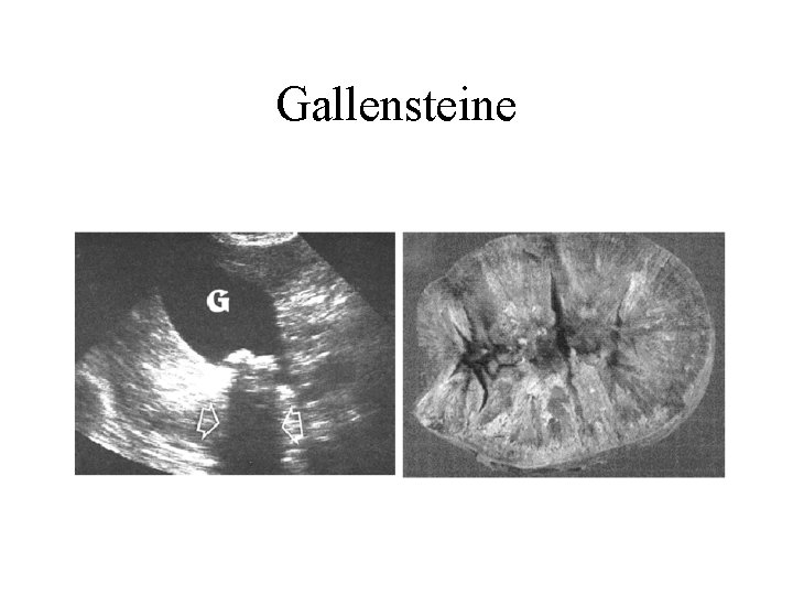 Gallensteine 