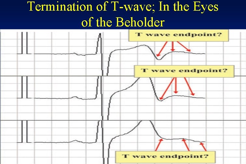 Termination of T-wave; In the Eyes of the Beholder 