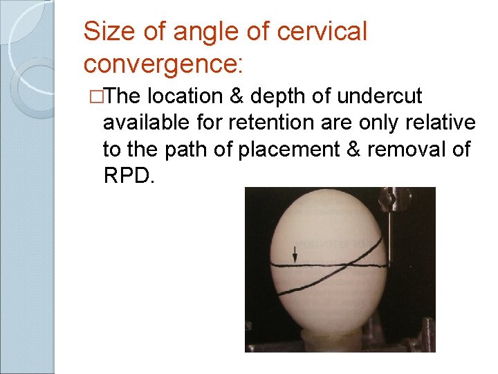 Size of angle of cervical convergence: �The location & depth of undercut available for