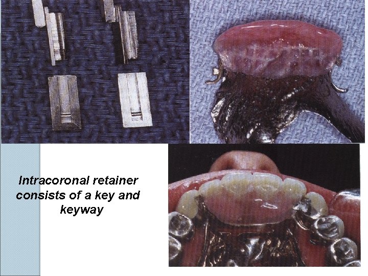 Intracoronal retainer consists of a key and keyway Intracoronal retainer consists of a key and keyway