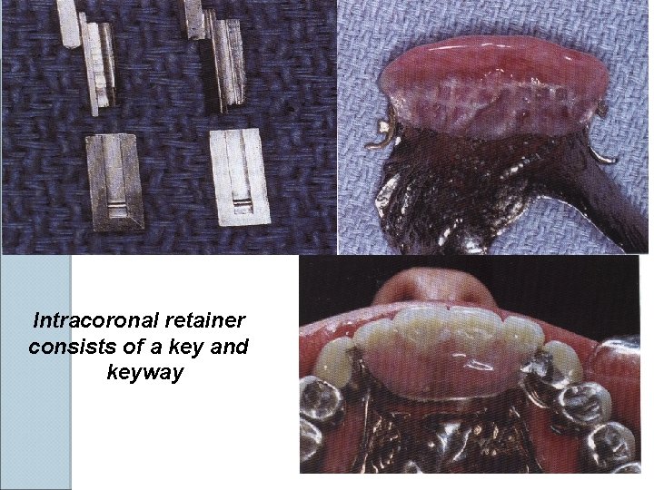 Intracoronal retainer consists of a key and keyway 