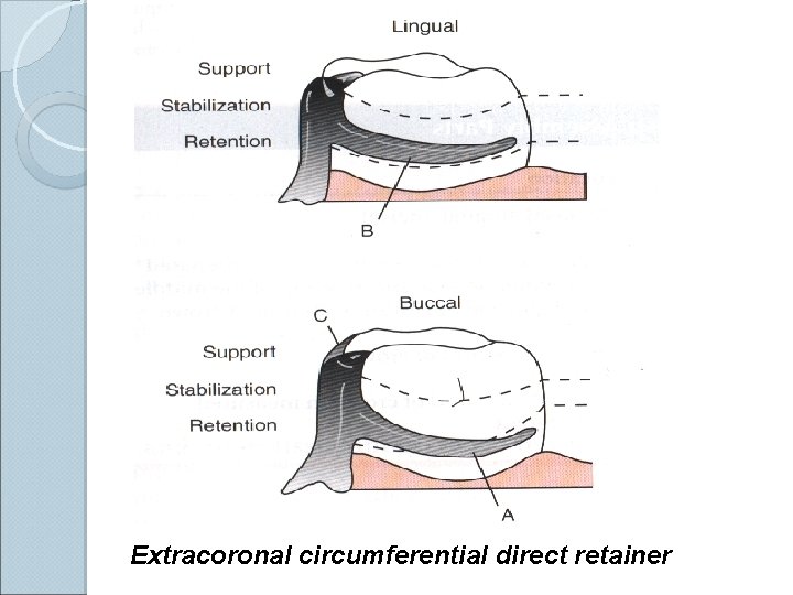 Extracoronal circumferential direct retainer 