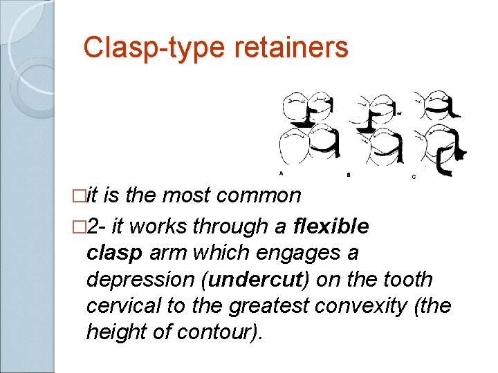 Clasp-type retainers �it is the most common � 2 - it works through a Clasp-type retainers �it is the most common � 2 - it works through a