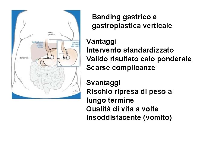 Banding gastrico e gastroplastica verticale Vantaggi Intervento standardizzato Valido risultato calo ponderale Scarse complicanze