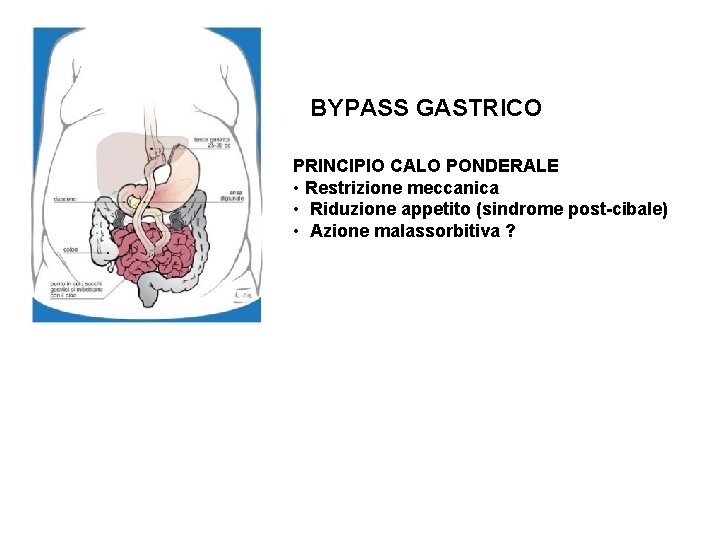 BYPASS GASTRICO PRINCIPIO CALO PONDERALE • Restrizione meccanica • Riduzione appetito (sindrome post-cibale) •