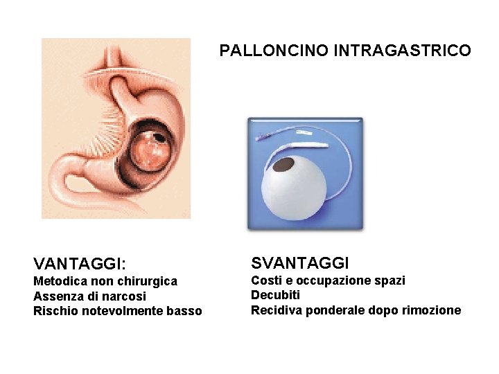 PALLONCINO INTRAGASTRICO VANTAGGI: Metodica non chirurgica Assenza di narcosi Rischio notevolmente basso SVANTAGGI Costi