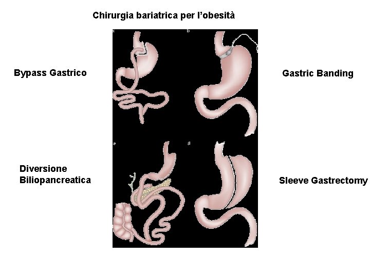 Chirurgia bariatrica per l’obesità Bypass Gastrico Diversione Biliopancreatica Gastric Banding Sleeve Gastrectomy 